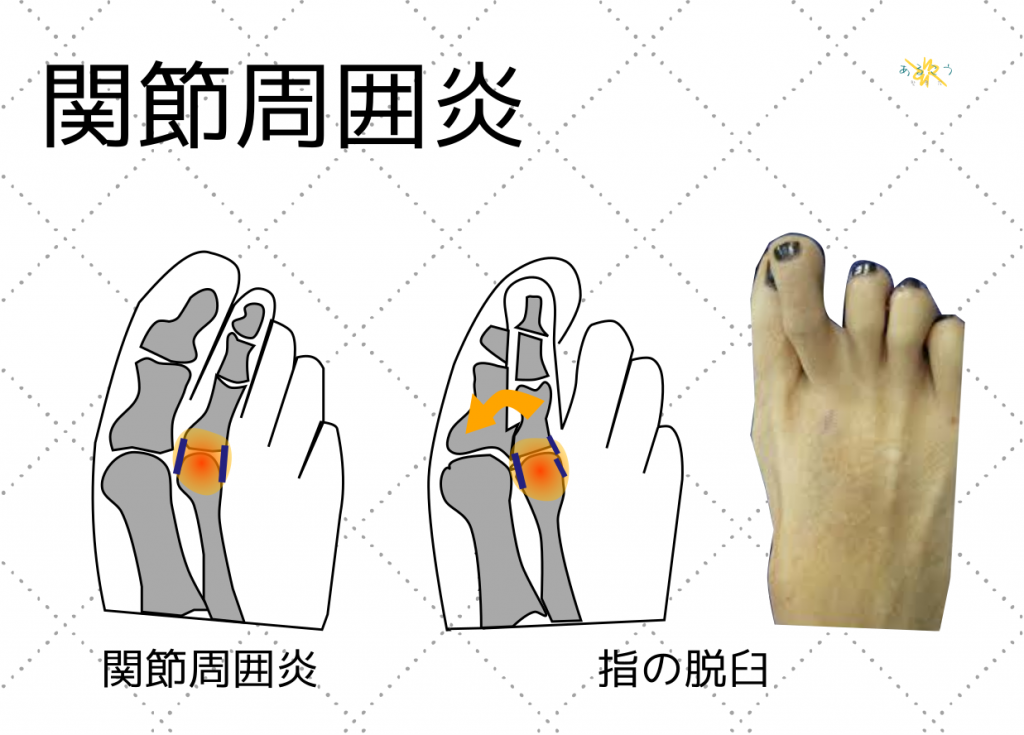 足指の関節周囲炎